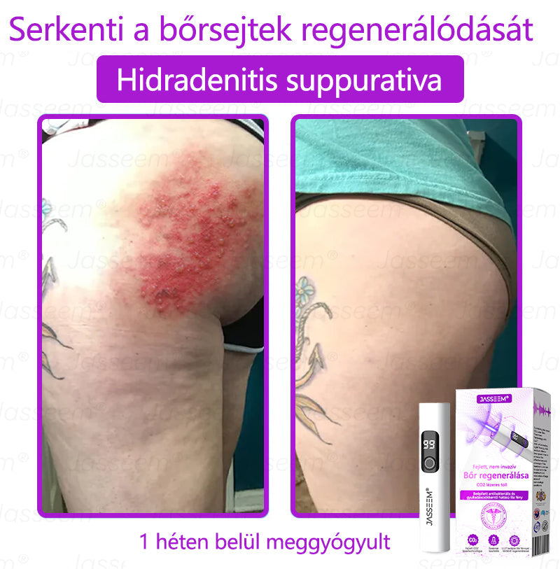 đđđŹđŹđđđŠÂźâ
â
Fejlett, nem invazĂv bĆrjavĂtĂł COâ lĂ©zeres toll đ (GyengĂ©den eltĂĄvolĂtja a szemölcsöket, anyajegyeket, öregsĂ©gi foltokat Ă©s bĆrkinövĂ©seket â fĂĄjdalom Ă©s gond nĂ©lkĂŒl!)