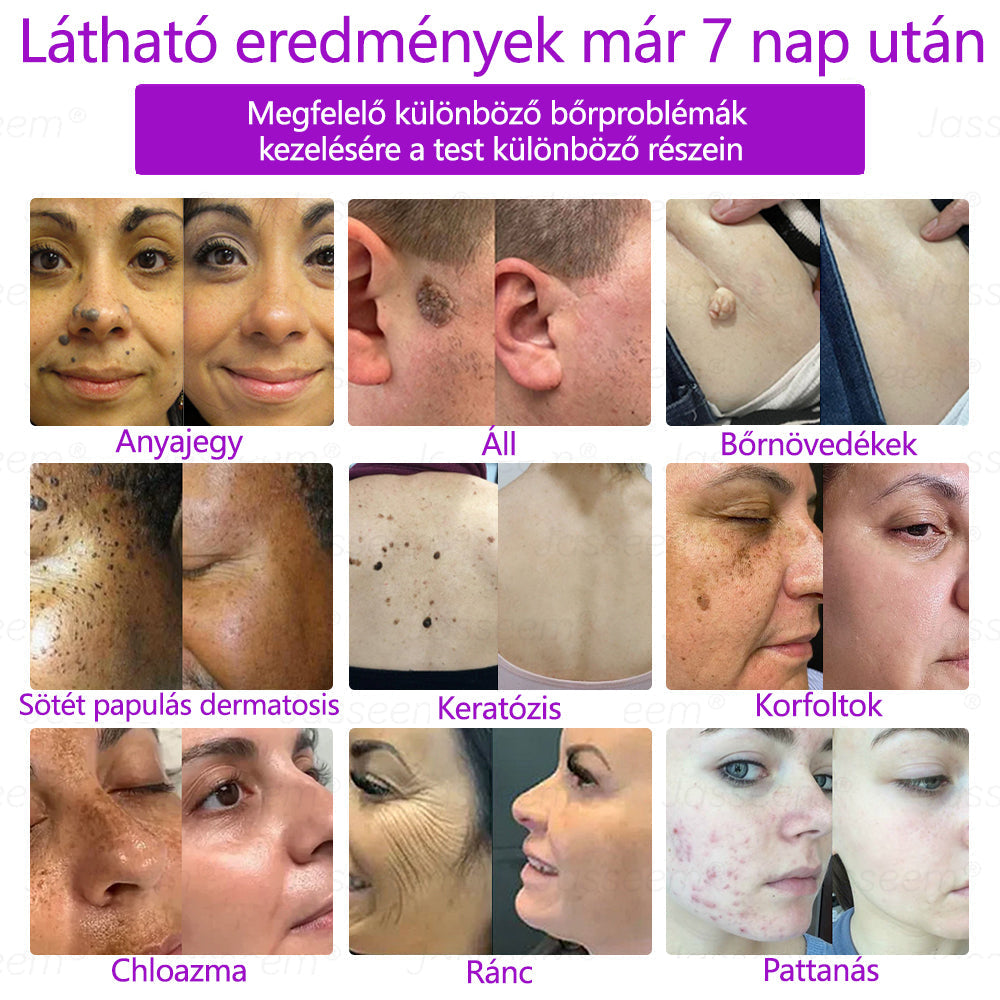 đđđŹđŹđđđŠÂźâ
â
Fejlett, nem invazĂv bĆrjavĂtĂł COâ lĂ©zeres toll đ (GyengĂ©den eltĂĄvolĂtja a szemölcsöket, anyajegyeket, öregsĂ©gi foltokat Ă©s bĆrkinövĂ©seket â fĂĄjdalom Ă©s gond nĂ©lkĂŒl!)