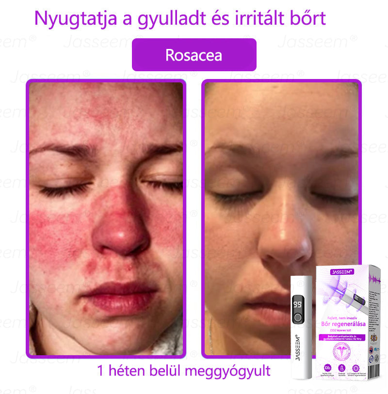 đđđŹđŹđđđŠÂźâ
â
Fejlett, nem invazĂv bĆrjavĂtĂł COâ lĂ©zeres toll đ (GyengĂ©den eltĂĄvolĂtja a szemölcsöket, anyajegyeket, öregsĂ©gi foltokat Ă©s bĆrkinövĂ©seket â fĂĄjdalom Ă©s gond nĂ©lkĂŒl!)