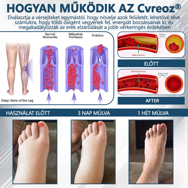 Cvreoz® Fekete kömény Ödéma méregtelenítő gyógynövénykrém🌿