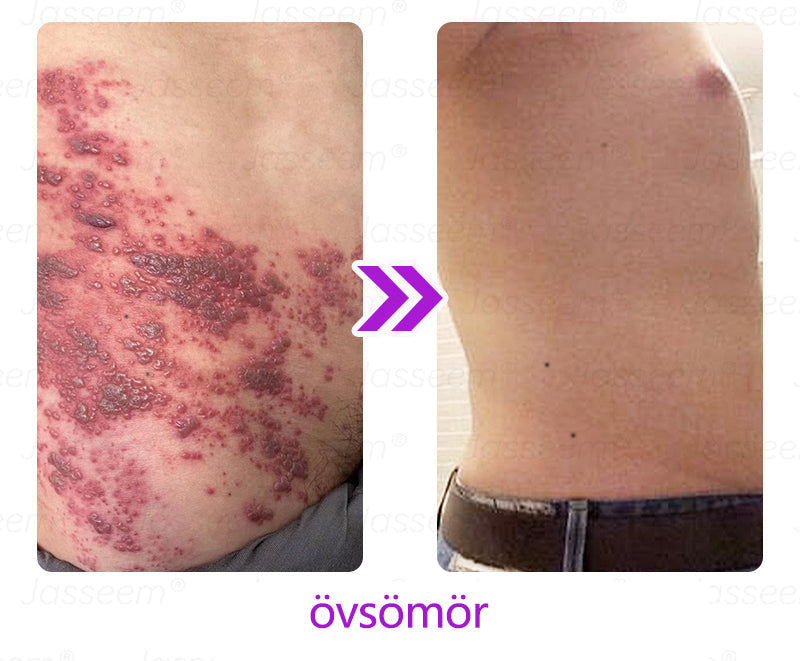 𝐉𝐚𝐬𝐬𝐞𝐞𝐦®✅✅ Fejlett, nem invazív bőrjavító CO₂ lézeres toll 🎉 (Gyengéden eltávolítja a szemölcsöket, anyajegyeket, öregségi foltokat és bőrkinövéseket – fájdalom és gond nélkül!)