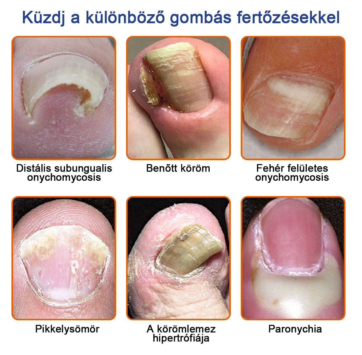 🌟🌟Furzero™ méhméreg körömgomba kezelési megoldás:Teljesen megoldja a körömgomba problémát🐝🐝