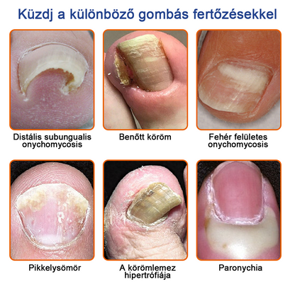 🌟🌟Furzero™ méhméreg körömgomba kezelési megoldás:Teljesen megoldja a körömgomba problémát🐝🐝