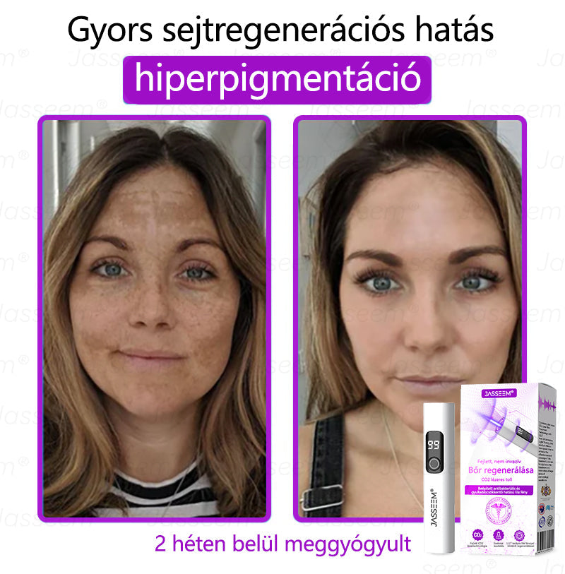 𝐉𝐚𝐬𝐬𝐞𝐞𝐦®✅✅ Fejlett, nem invazív bőrjavító CO₂ lézeres toll 🎉 (Gyengéden eltávolítja a szemölcsöket, anyajegyeket, öregségi foltokat és bőrkinövéseket – fájdalom és gond nélkül!)